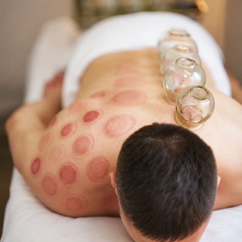 Cupping